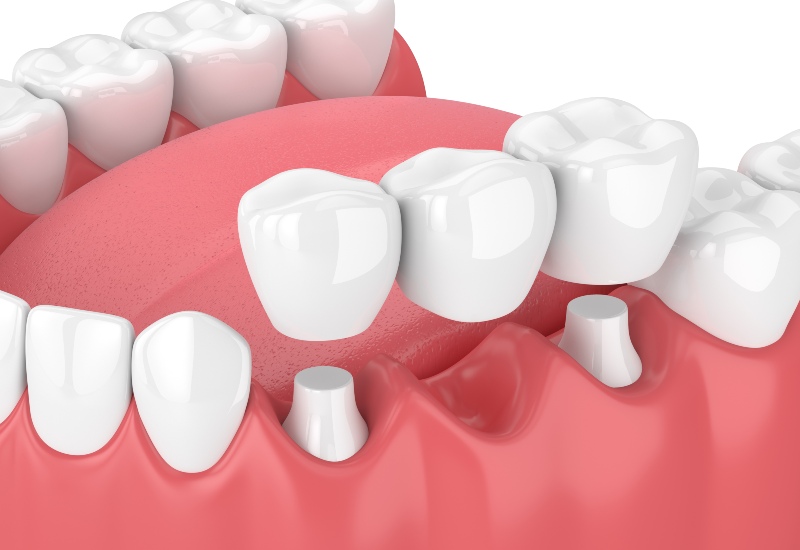 Dental Crowns with CEREC Technology in St. Charles, MO