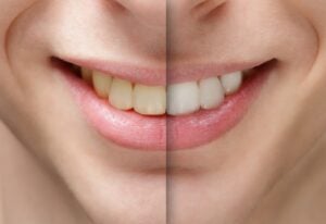 Smile Makeover in St. Charles, MO