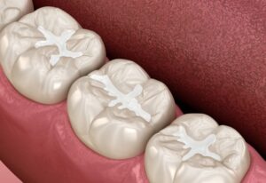 Tooth Filling Services in St. Charles, MO
