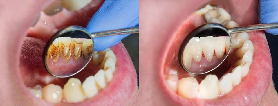 Effects of Nicotine on Teeth in St. Charles, MO