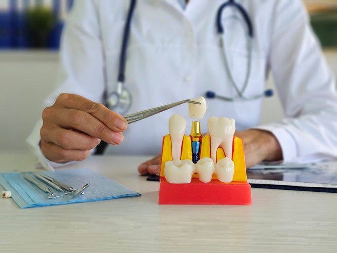 dental implant stages